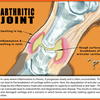 Arthritic leg joint.