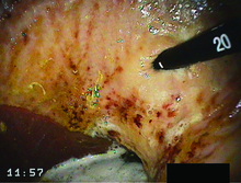 A grade 3 ulcer in a horse's stomach.