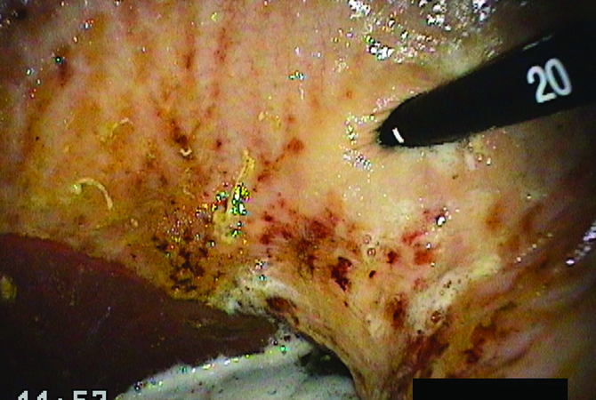 A grade 3 stomach ulcer in a horse's stomach