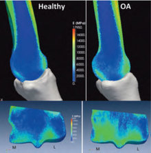 Healthy and Osteoarthritic Bone Density-Green = higher density bone